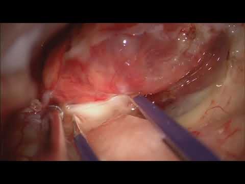 Hemangioblastoma of the pons and middle cerebellar peduncle