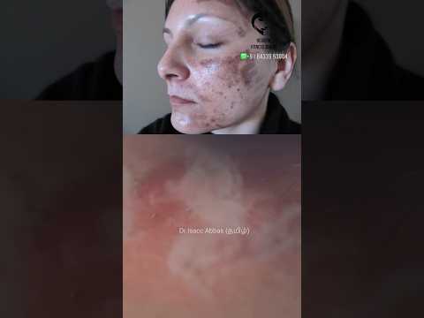 லேசர் சருமத்தை பொசிக்கி விடுமா? Does laser burn skin? Dr.Isacc Abbas