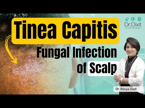 Fungal infection in hair scalp treatment | Tinea capitis scalp |fungal infection treatment,bangalore