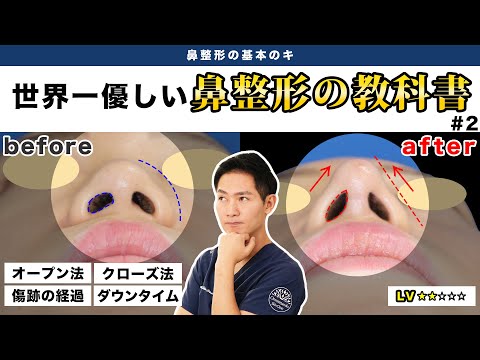 【鼻整形】結論、オープン法がオススメです！鼻整形の基本のキ＜#２＞