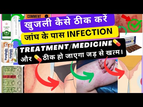 खुजली कैसे ठीक करें | Fungal infection | Thigh infection | skin infection कैसे ठीक करें |💊💉Medicine