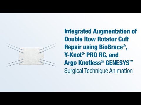 Augmentation of Double Row RCR using BioBrace®, Y-Knot® PRO RC, and Argo Knotless® GENESYS™ - CONMED