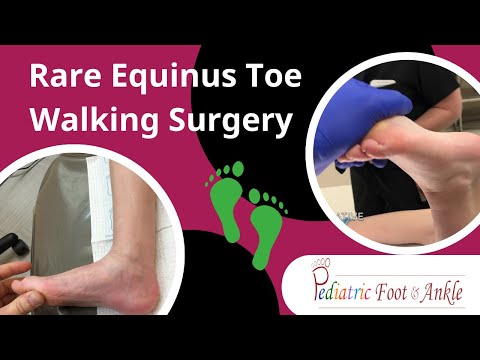 Rare Form of Equinus Toe Walking Surgery Success 6 Month Recovery