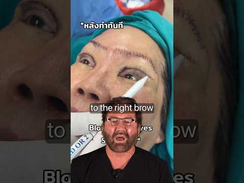 SHOCKING Brow Lift Trend (Black Swan) Plastic Surgeon Reacts