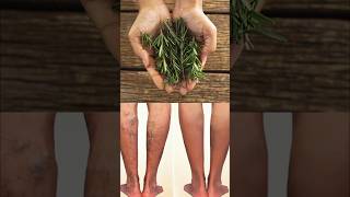 Get Rid Of Varicose Veins & Joint Pain |  Effective Home Remedies for Varicose Veins #shortsvideo