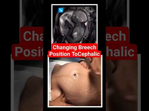 changing breech baby to cephalic position #brechbaby #babyultrasound #babyposition#pregnancy