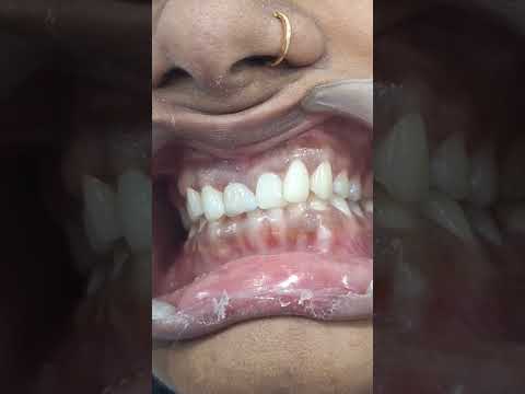 Zirconia Crown Fixation for Discoloured Teeth #shorts #ytshorts #saanvidental #trendingshorts