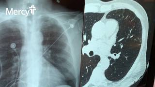 LDCT Scan vs  Traditional X Ray