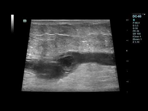 Superficial Thrombophlebitis-thrombosis of Great Saphenous Vein