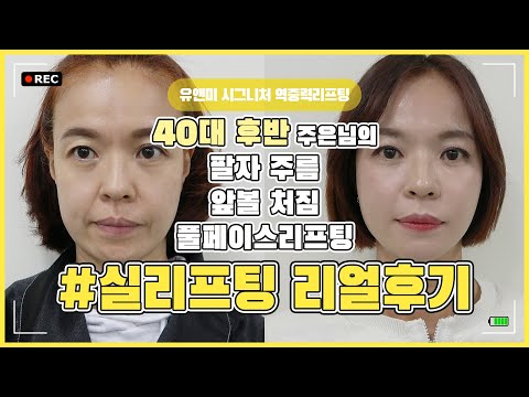 [ 리얼후기 ]  40대실리프팅 / 팔자주름리프팅   /   앞볼처짐리프팅  / 이중턱리프팅 /  실리프팅후기