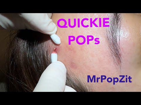 Quickie keratin plug core pops. Acne extractions. Link below to MrPopZit Live.