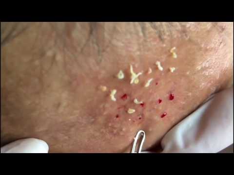 Milia, Skill Acne Remove, Blackhead Extraction