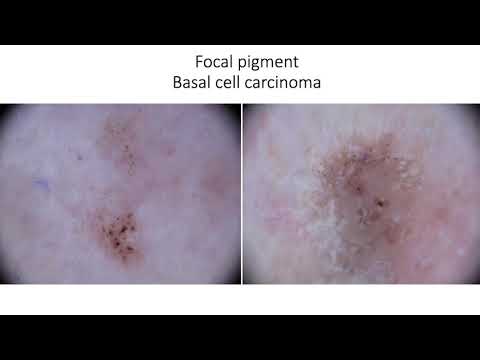 Pink Lesions on the Legs - Dr. Sonia Segura