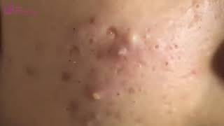 Blackheads Under Skin Extraction |poppy | 12st Treatment