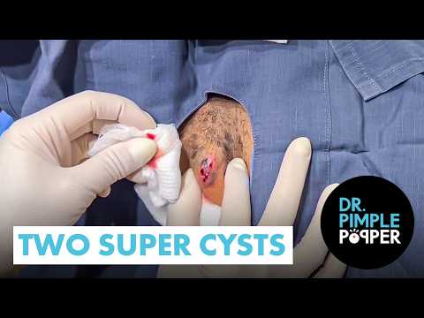 Two Super Cysts