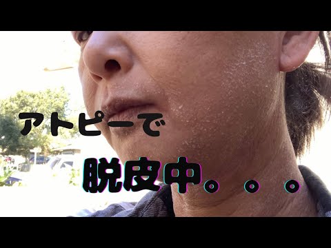 【アラフィフ】アトピーで脱皮中。結構凹んでる。