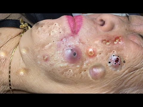 new blackheads this week