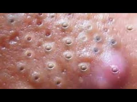 large blackheads new this week