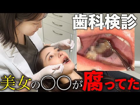 【密着】虫歯が7本も？！美女の歯科治療！