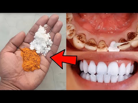 Dentists don't want you to know: Removes tartar and whitens teeth in 2 minutes