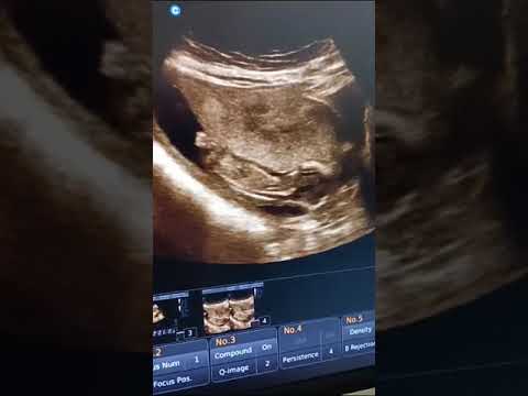 Normal fetus  #pregnancy  #health #sonographer #ultrasoundtech #anatomy #ultrasound   #doppler