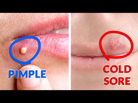 What's the Difference Between a Cold Sore and Pimple?