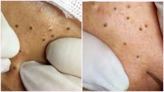 Blackheads Removal Best Pimple Popping Videos