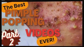 The  BEST pimple POPPING videos EVER (p2)