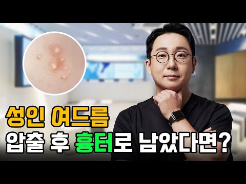 💦성인여드름과 학생여드름의 차이는?│성인여드름