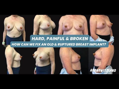 A case of Hard, Painful and Broken breast.