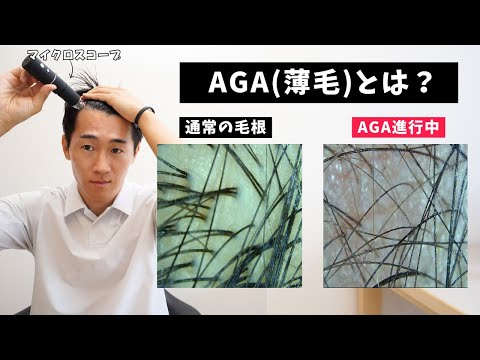 【生え際】AGA・薄毛の実態はこれです。初期AGA・重度AGAの違いとは？【AGA治療】