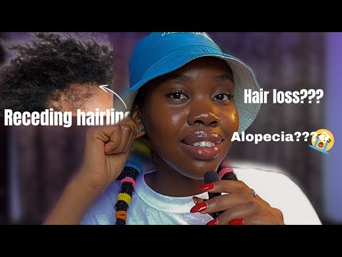 HOW TO Avoid Receding Hairline: Hair Loss Solution