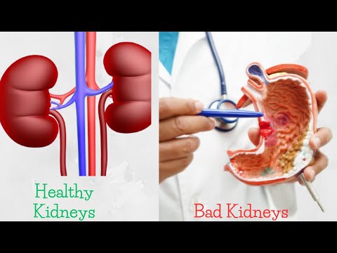 10 Worst Foods That Destroy Your Kidney Health: Protect Your Kidneys Now