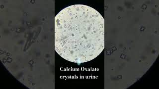 Calcium oxalate crystal in urine #urineanalysis #urine_infection