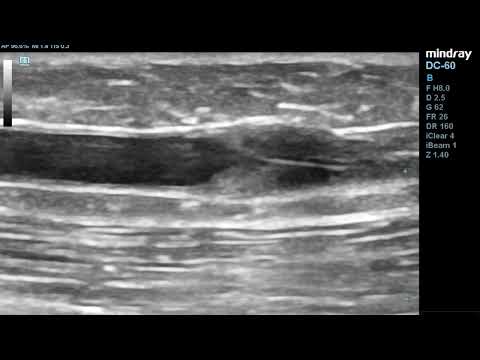 Normal Valve of Great Saphenous Vein (GSV), Duplex Ultrasound -B-Mode