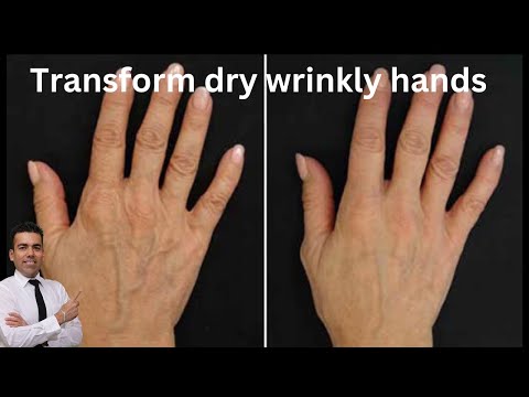 Most Attacked body Part by chemicals, your Hands! What to do and how to save them? Home Remedy!