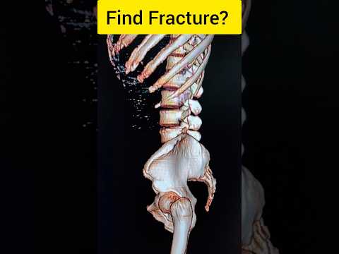 Find Frcature In Pubic Bone