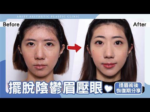 回復青春緊緻、眉壓眼細紋下垂掰掰！內視鏡提眉術後分享，直接來聊聊術後恢復期及拉皮疤痕的狀況吧！