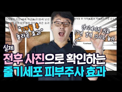 17년차 청담의사도 놀란 모즈셀 줄기세포 피부주사의 놀라운 결과. ㅣ ㅣ모즈의원- 모즈클리닉