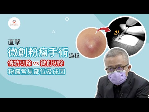 【手術室直擊】微創粉瘤手術｜粉瘤放膿｜粉瘤治療過程｜健康蘋台