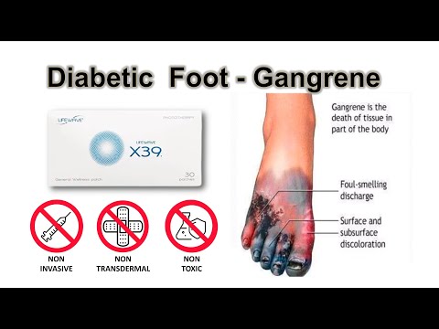 LifeWave X39 Testimonial - Diabetic Foot (Gangrene)