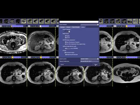 How to read a Iron Quantification MRI