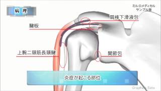 肩関節周囲炎（五十肩）／2分で分かる医療動画辞典　ミルメディカル