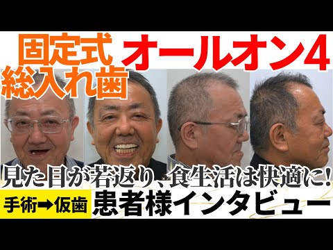 【オールオン4】患者様インタビュー🦷固定式総入れ歯で見た目が若返り食生活も変わります✨