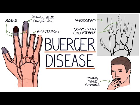 Understanding Buerger Disease (Thromboangiitis Obliterans)