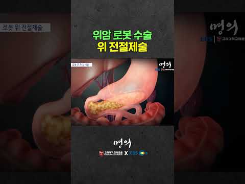 위암 로봇수술 하는 법