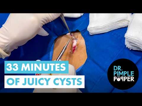 33 Minutes of Juicy Cysts