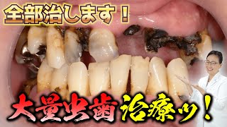 真っ黒になった虫歯８本抜歯から入れ歯装着まで　8 pitch-black cavities extracted and partial dentures fitted dental treatment