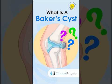 Baker’s Cyst #anatomy #physiotharapy #physicaltherapy #bakerscyst #kneepain