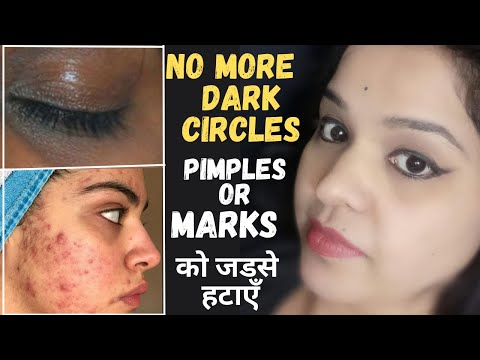 remove acne pimples marks dark circles & pigmentation get 100% clear spotless glowing skin naturally